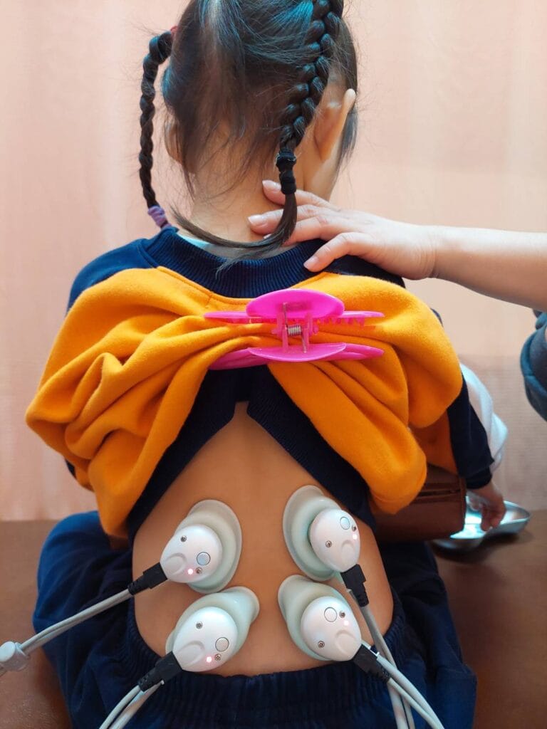 兒童雷射針灸治療情形，孩子坐著即可完成
